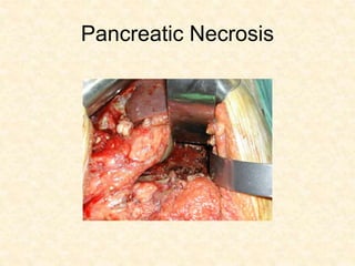 Pancreatic Necrosis
 