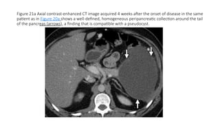 Figure 21a Axial contrast-enhanced CT image acquired 4 weeks after the onset of disease in the same
patient as in Figure 20a shows a well-defined, homogeneous peripancreatic collection around the tail
of the pancreas (arrows), a finding that is compatible with a pseudocyst.
 