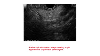 Endoscopic ultrasound image showing bright
hyperechoic of pancreas parenchyma.
 