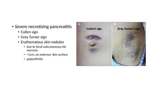 • Severe necrotizing pancreatitis
• Cullen sign
• Grey Turner sign
• Erythematous skin nodules
• due to focal subcutaneous fat
necrosis
• <1cm, on extensor skin surface
• polyarthritis
 