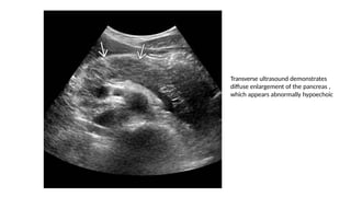 Transverse ultrasound demonstrates
diffuse enlargement of the pancreas ,
which appears abnormally hypoechoic
 
