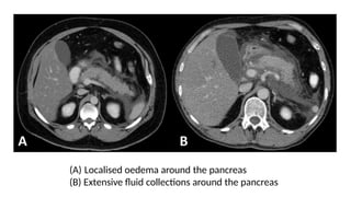 (A) Localised oedema around the pancreas
(B) Extensive fluid collections around the pancreas
 