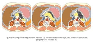 Figure 1 Drawings illustrate pancreatic necrosis (a), peripancreatic necrosis (b), and combined pancreatic-
peripancreatic necrosis (c).
 