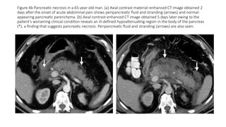 Figure 4b Pancreatic necrosis in a 65-year-old man. (a) Axial contrast material–enhanced CT image obtained 2
days after the onset of acute abdominal pain shows peripancreatic fluid and stranding (arrows) and normal-
appearing pancreatic parenchyma. (b) Axial contrast-enhanced CT image obtained 5 days later owing to the
patient’s worsening clinical condition reveals an ill-defined hypoattenuating region in the body of the pancreas
(*), a finding that suggests pancreatic necrosis. Peripancreatic fluid and stranding (arrows) are also seen.
 