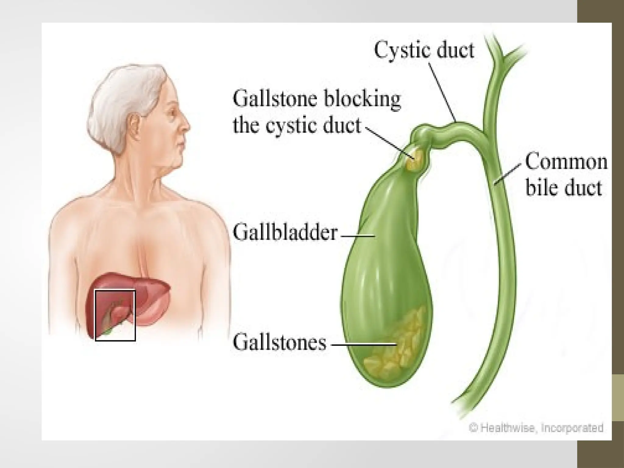 acute-pancreatitis-and-gall-stoness-pptx