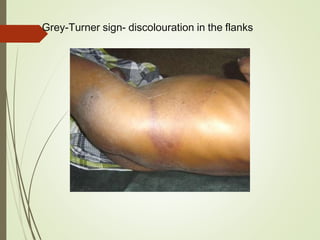 Grey-Turner sign- discolouration in the flanks
 