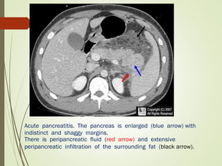 Acute pancreatitis. The pancreas is enlarged (blue arrow) with
indistinct and shaggy margins.
There is peripancreatic fluid (red arrow) and extensive
peripancreatic infiltration of the surrounding fat (black arrow).
 