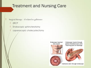Treatment and Nursing Care
 Surgical therapy – if related to gallstones
 ERCP
 Endoscopic sphincterotomy
 Laparoscopic cholecystectomy
 