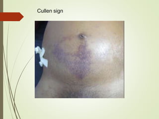 Cullen sign
 