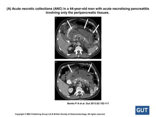 (A) Acute necrotic collections (ANC) in a 44-year-old man with acute necrotising pancreatitis
involving only the peripancreatic tissues.
Banks P A et al. Gut 2013;62:102-111
Copyright © BMJ Publishing Group Ltd & British Society of Gastroenterology. All rights reserved.
 