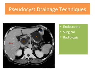 Pseudocyst Drainage TechniquesPseudocyst Drainage Techniques
• Endoscopic
• Surgical
• Radiologic
• Endoscopic
• Surgical
• Radiologic
Acute Pancreatitis
LiverLiver
PCPC
PCPC
StomStom
 