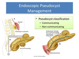 Endoscopic Pseudocyst
Management
Endoscopic Pseudocyst
Management
Acute Pancreatitis
• Pseudocyst classification
– Communicating
– Non-communicating
• Pseudocyst classification
– Communicating
– Non-communicating
 