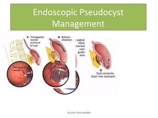 Endoscopic Pseudocyst
Management
Acute Pancreatitis
 