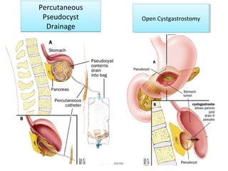 Percutaneous
Pseudocyst
Drainage
Percutaneous
Pseudocyst
Drainage
Acute Pancreatitis
Open CystgastrostomyOpen Cystgastrostomy
 