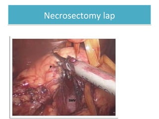 Necrosectomy lapNecrosectomy lap
Acute Pancreatitis
 