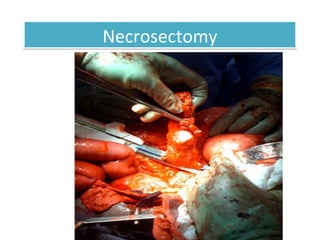 NecrosectomyNecrosectomy
Acute Pancreatitis
 