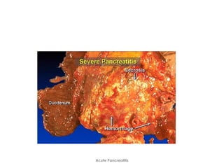Acute Pancreatitis
 