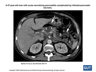 A 47-year-old man with acute necrotising pancreatitis complicated by infected pancreatic
necrosis.
Banks P A et al. Gut 2013;62:102-111
Copyright © BMJ Publishing Group Ltd & British Society of Gastroenterology. All rights reserved.
 