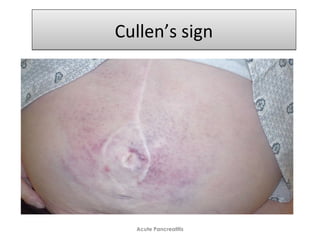 Cullen’s signCullen’s sign
Acute Pancreatitis
 