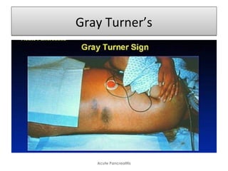Gray Turner’sGray Turner’s
Acute Pancreatitis
 