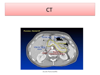 CTCT
Acute Pancreatitis
 