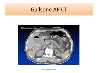 Gallsone AP CTGallsone AP CT
Acute Pancreatitis
 