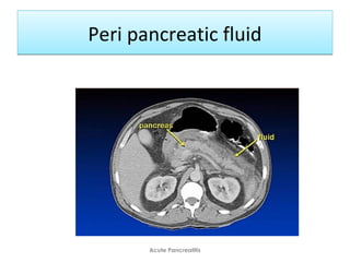 Peri pancreatic fluidPeri pancreatic fluid
Acute Pancreatitis
 
