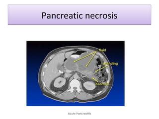 Pancreatic necrosisPancreatic necrosis
Acute Pancreatitis
 