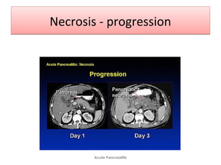 Necrosis - progressionNecrosis - progression
Acute Pancreatitis
 