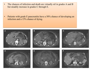 • The chances of infection and death are virtually nil in grades A and B
but steadily increase in grades C through E.
• Patients with grade E pancreatitis have a 50% chance of developing an
infection and a 15% chance of dying.
• The chances of infection and death are virtually nil in grades A and B
but steadily increase in grades C through E.
• Patients with grade E pancreatitis have a 50% chance of developing an
infection and a 15% chance of dying.
Acute Pancreatitis
 