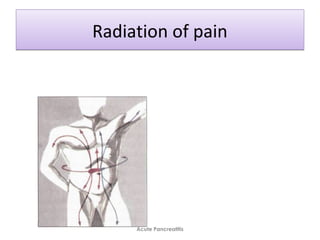 Radiation of painRadiation of pain
Acute Pancreatitis
 