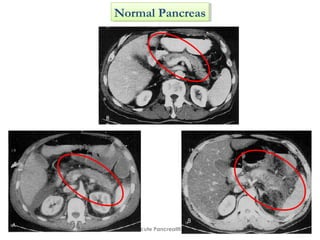 Acute Pancreatitis
Normal PancreasNormal Pancreas
 