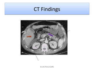 CT FindingsCT Findings
Acute Pancreatitis
Tail Indistinct
Intraperitoneal fluid
PANC
PANC
LIVERLIVER
 