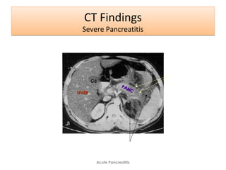 CT Findings
Severe Pancreatitis
CT Findings
Severe Pancreatitis
Acute Pancreatitis
Peripancreatic edema
and inflammation
Unenhancing
Necrosis
PANC
PANC
LIVERLIVER
GBGB
 