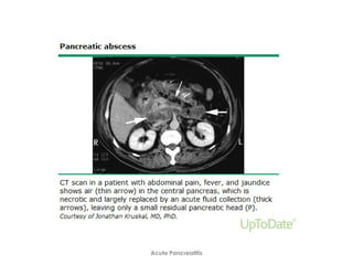 Acute Pancreatitis
 