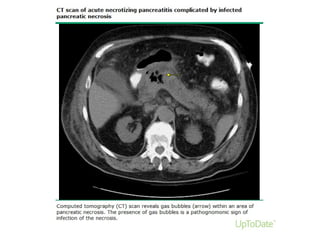 Acute Pancreatitis
 