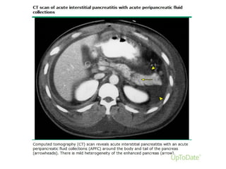 Acute Pancreatitis
 
