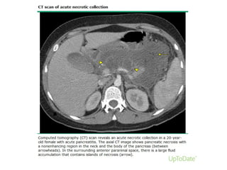 Acute Pancreatitis
 