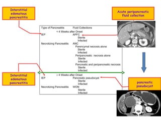 Interstitial
edematous
pancreatitis
Interstitial
edematous
pancreatitis
Acute peripancreatic
fluid collection
pancreatic
pseudocyst
 