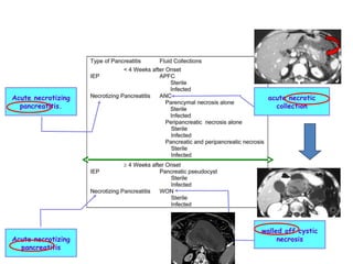 Acute necrotizing
pancreatitis.
Acute necrotizing
pancreatitis
acute necrotic
collection
walled off cystic
necrosis
 