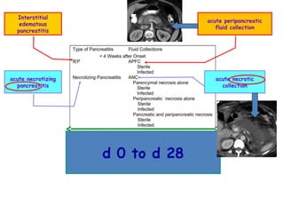 acute necrotizing
pancreatitis
acute necrotic
collection
Interstitial
edematous
pancreatitis
acute peripancreatic
fluid collection
d 0 to d 28
 
