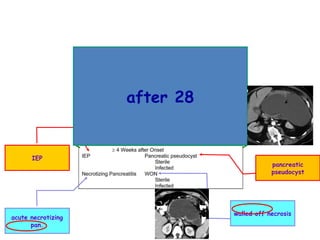 acute necrotizing
pan.
walled off necrosis
IEP
pancreatic
pseudocyst
after 28
 