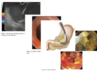 Acute Pancreatitis
 