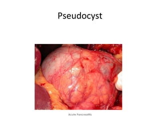 Pseudocyst
Acute Pancreatitis
 