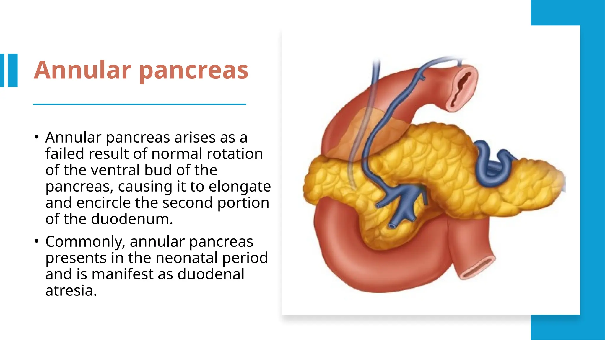 updated guidelies of acute pancreatitis .pptx