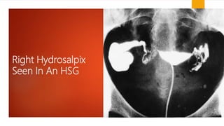 Right Hydrosalpix
Seen In An HSG
 