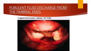 PURULENT FLUID DISCHARGE FROM
THE FIMBRIAL ENDS
 