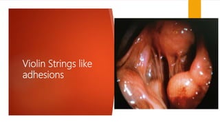 Violin Strings like
adhesions
 