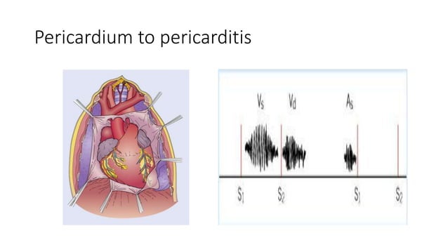 12 Lead ECG in acute pericarditis | PPT
