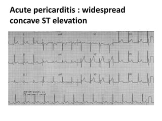 Acute pericarditis : widespread
concave ST elevation
 